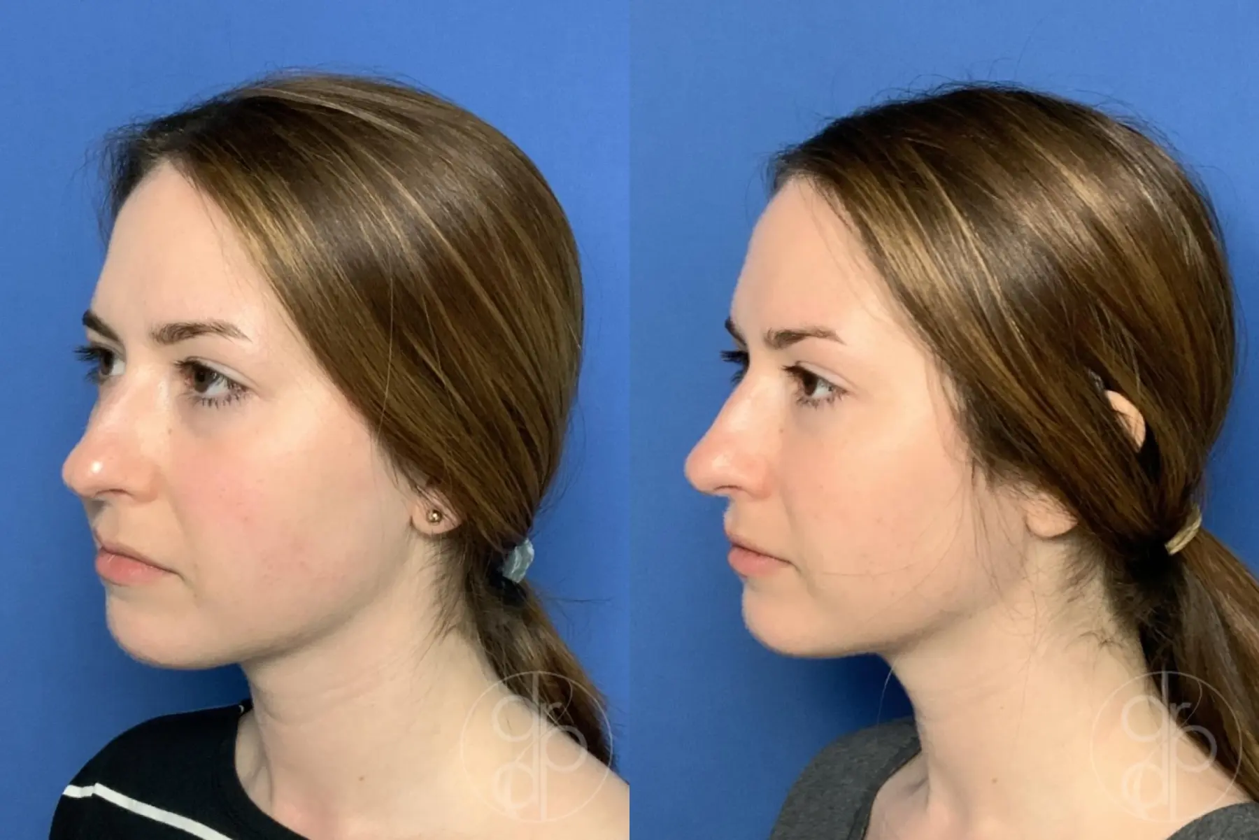 patient 13355 fillers before and after result - Before and After 2