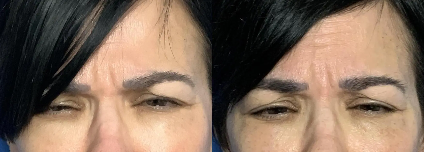 patient 13391 fillers before and after result - Before and After 1