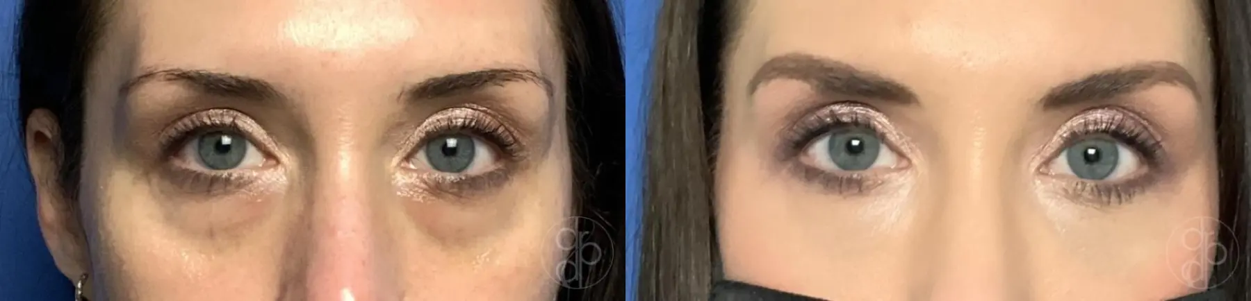 patient 12747 fillers before and after result - Before and After