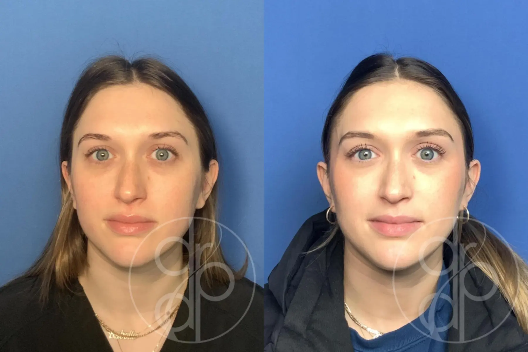 Injectables: Patient 11 - Before and After 1