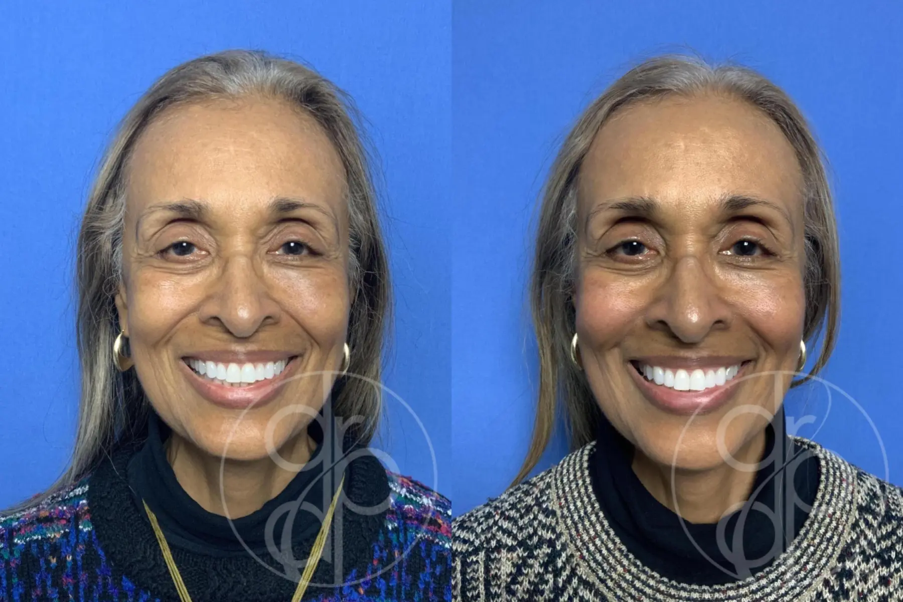 Injectables: Patient 12 - Before and After 1