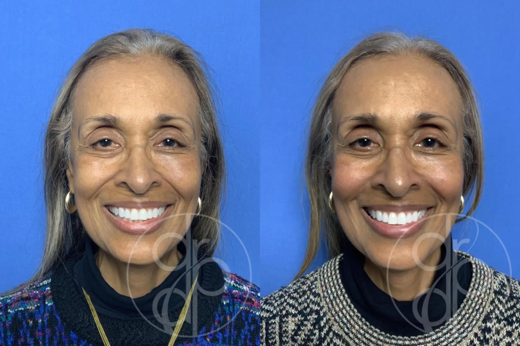 patient 11973 fillers before and after result - Before and After