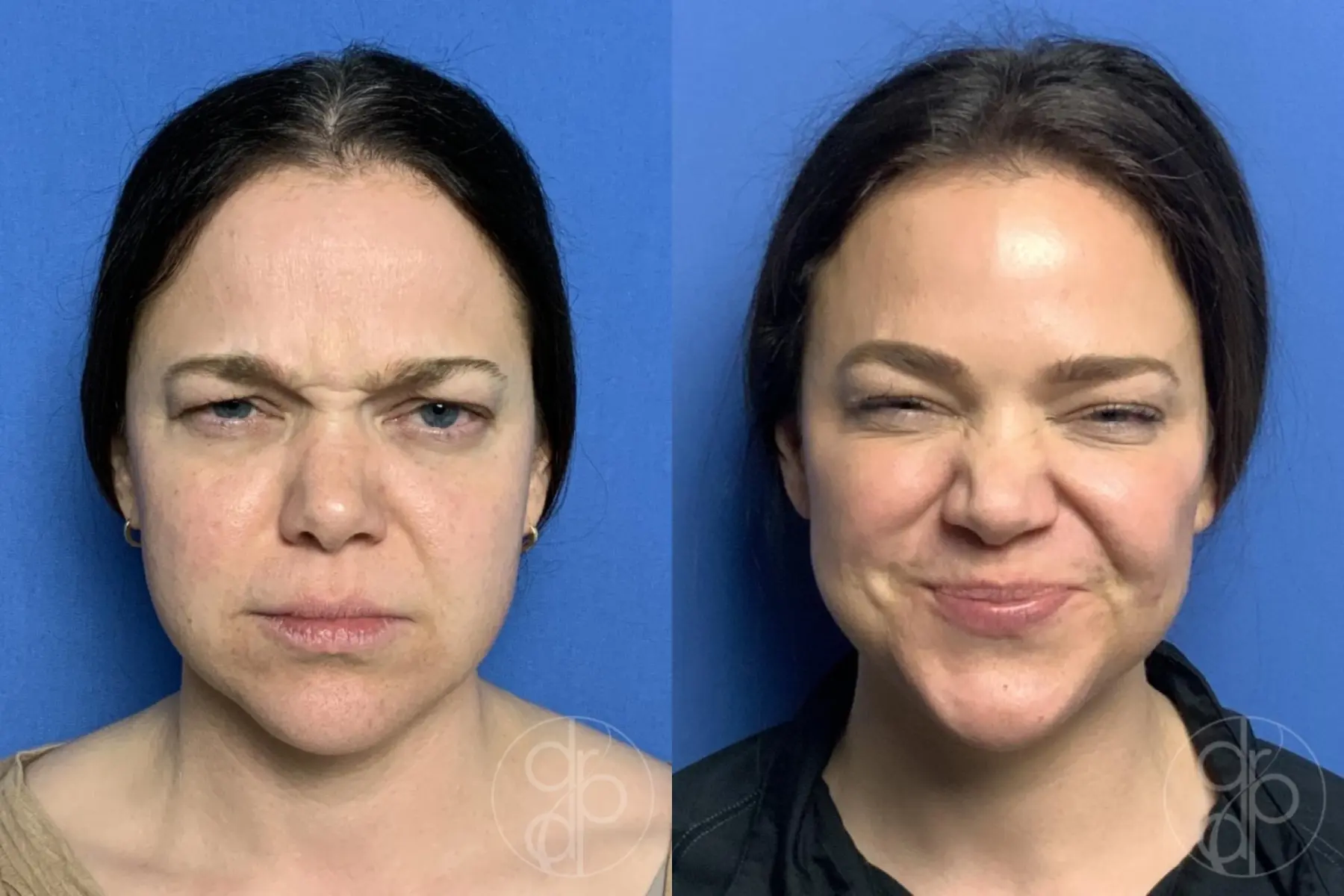patient 12559 injectables before and after result - Before and After 4