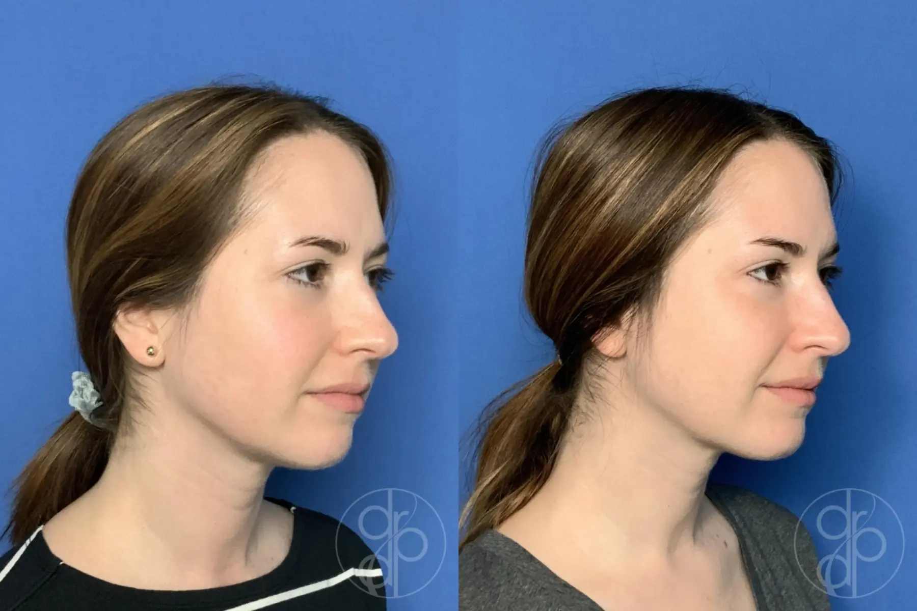 patient 13355 fillers before and after result - Before and After 3