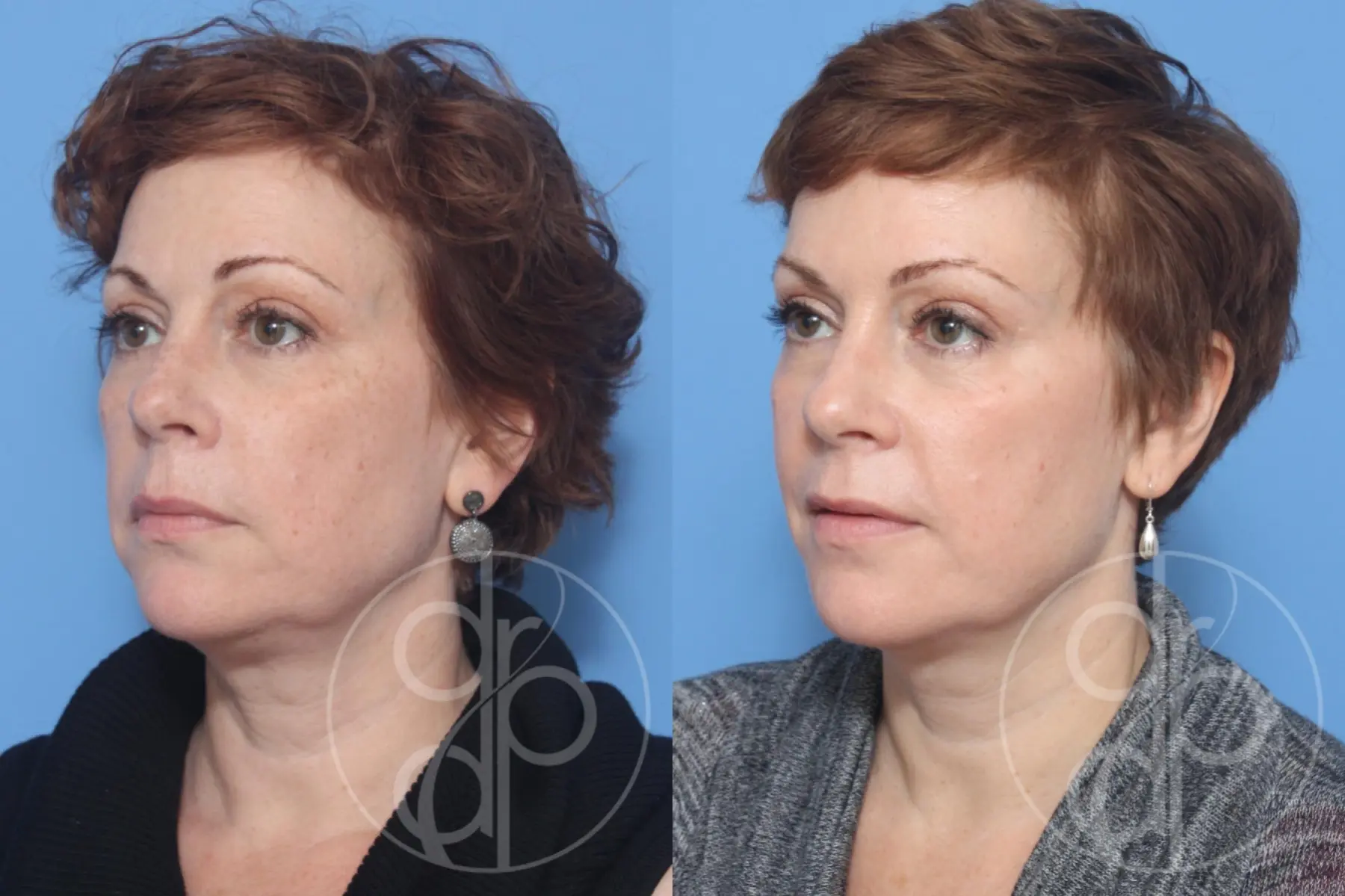 Injectables: Patient 10 - Before and After 1