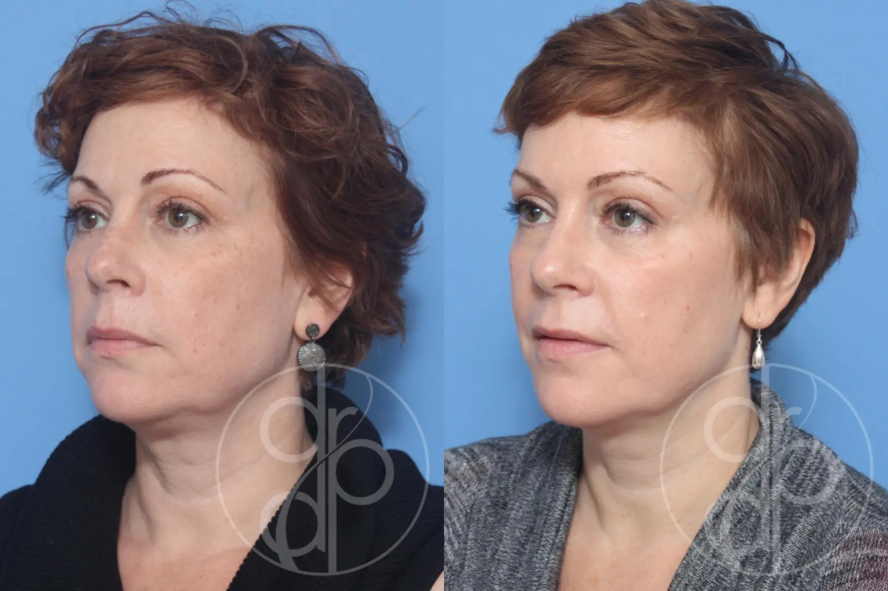 patient 12810 fillers before and after result - Before and After