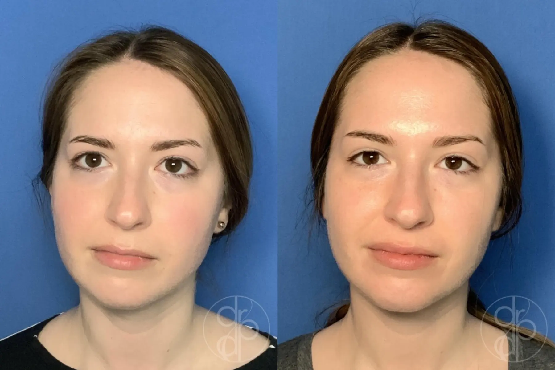 patient 13355 fillers before and after result - Before and After 1
