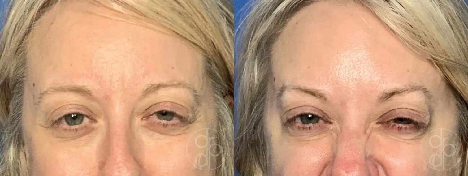 patient 14169 injectables before and after result - Before and After 3