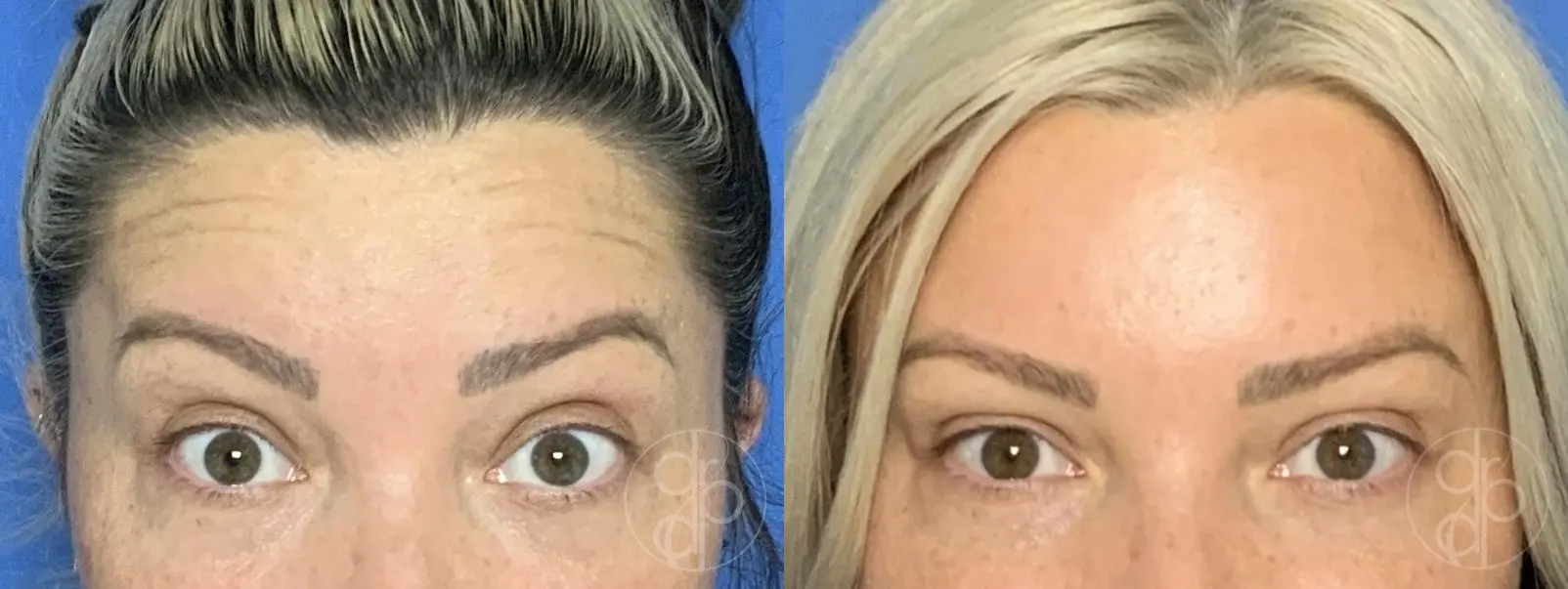 patient 13983 injectables before and after result - Before and After 2