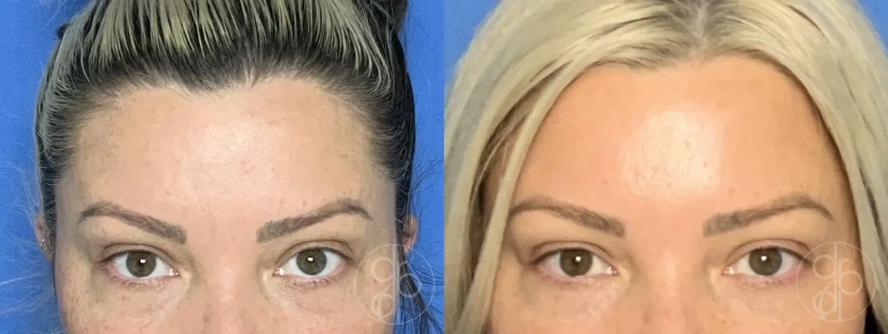 patient 13983 injectables before and after result - Before and After