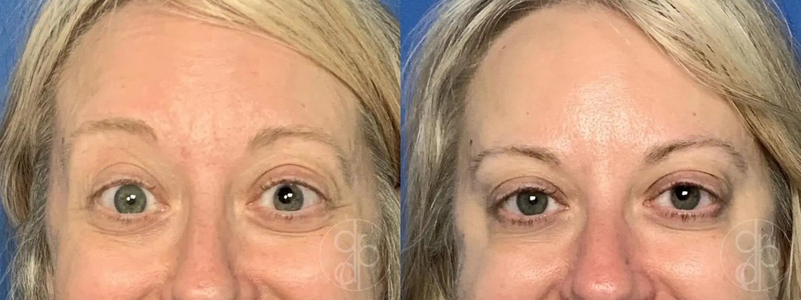 patient 14169 injectables before and after result - Before and After 4
