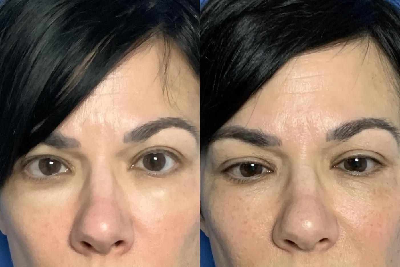 patient 13391 fillers before and after result - Before and After 3