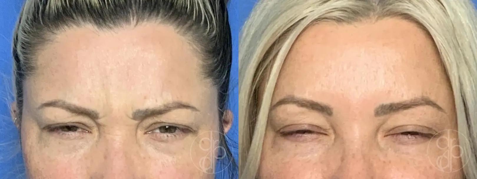 patient 13983 injectables before and after result - Before and After 3