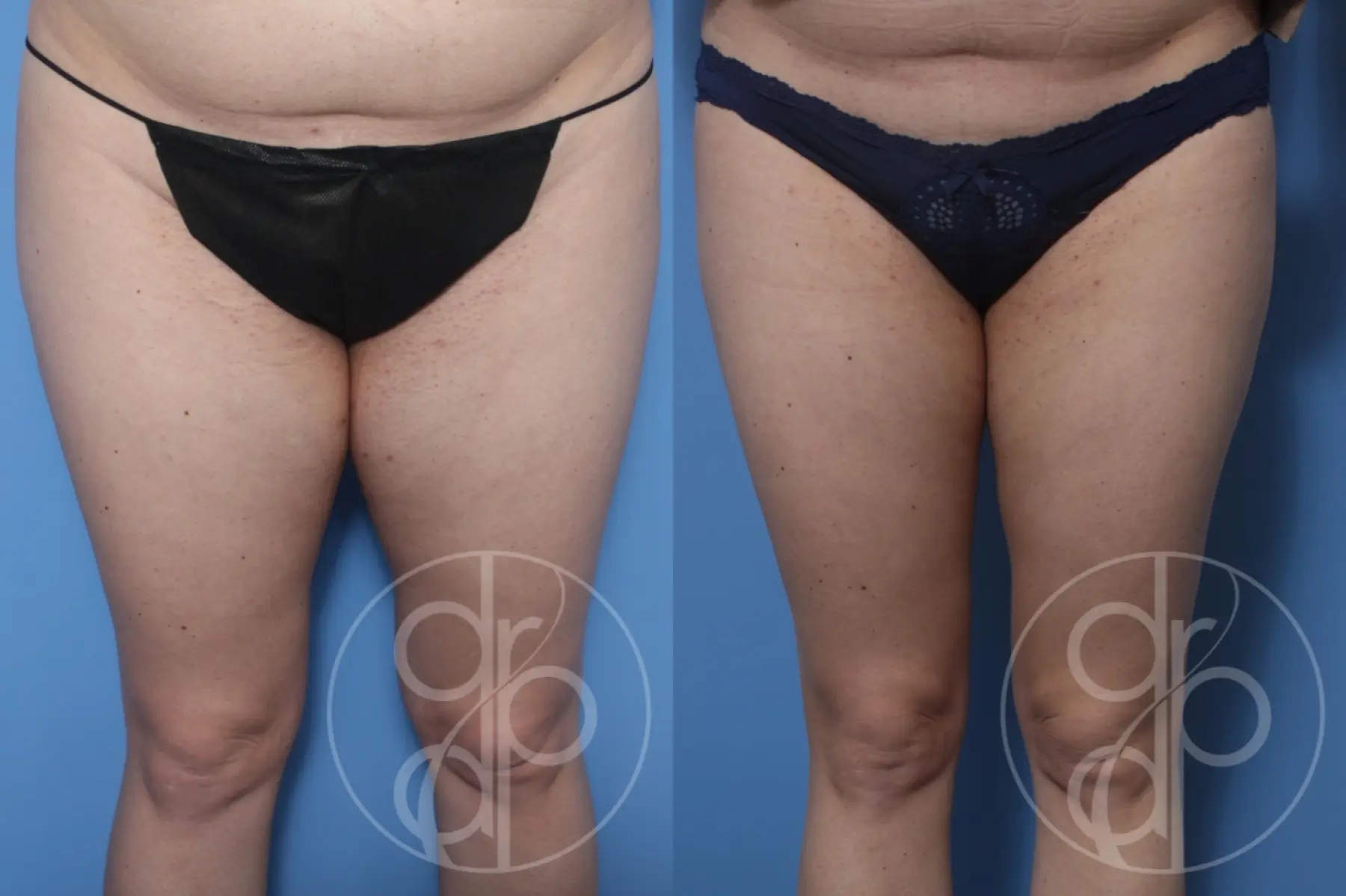 Liposuction: Patient 1 - Before and After  