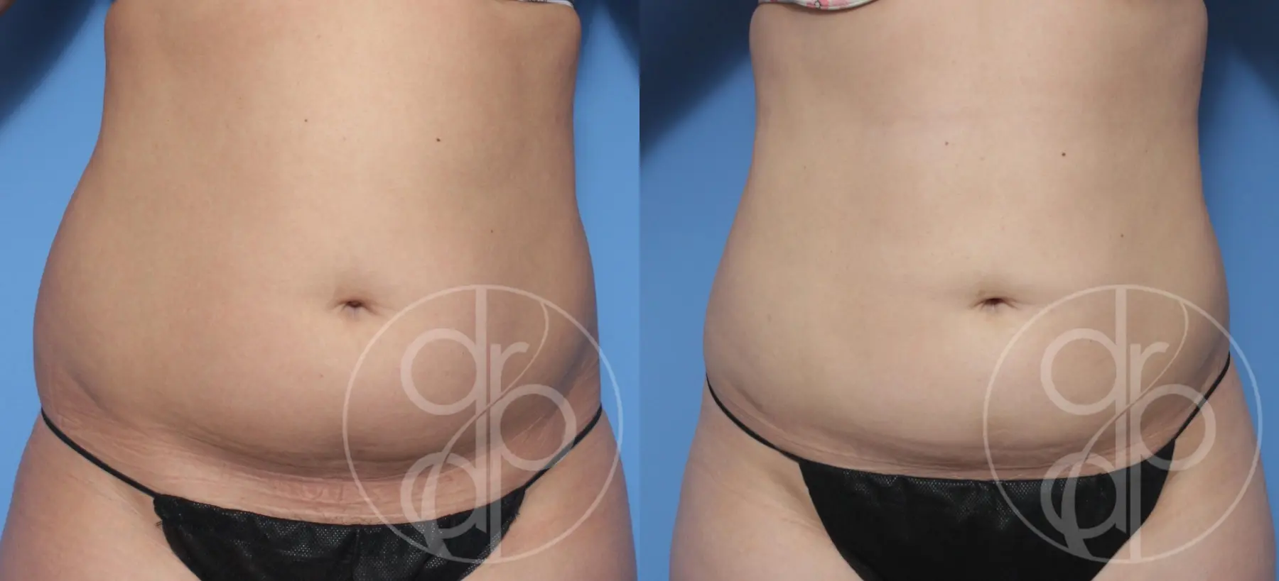 patient 12394 liposuction before and after result - Before and After 1