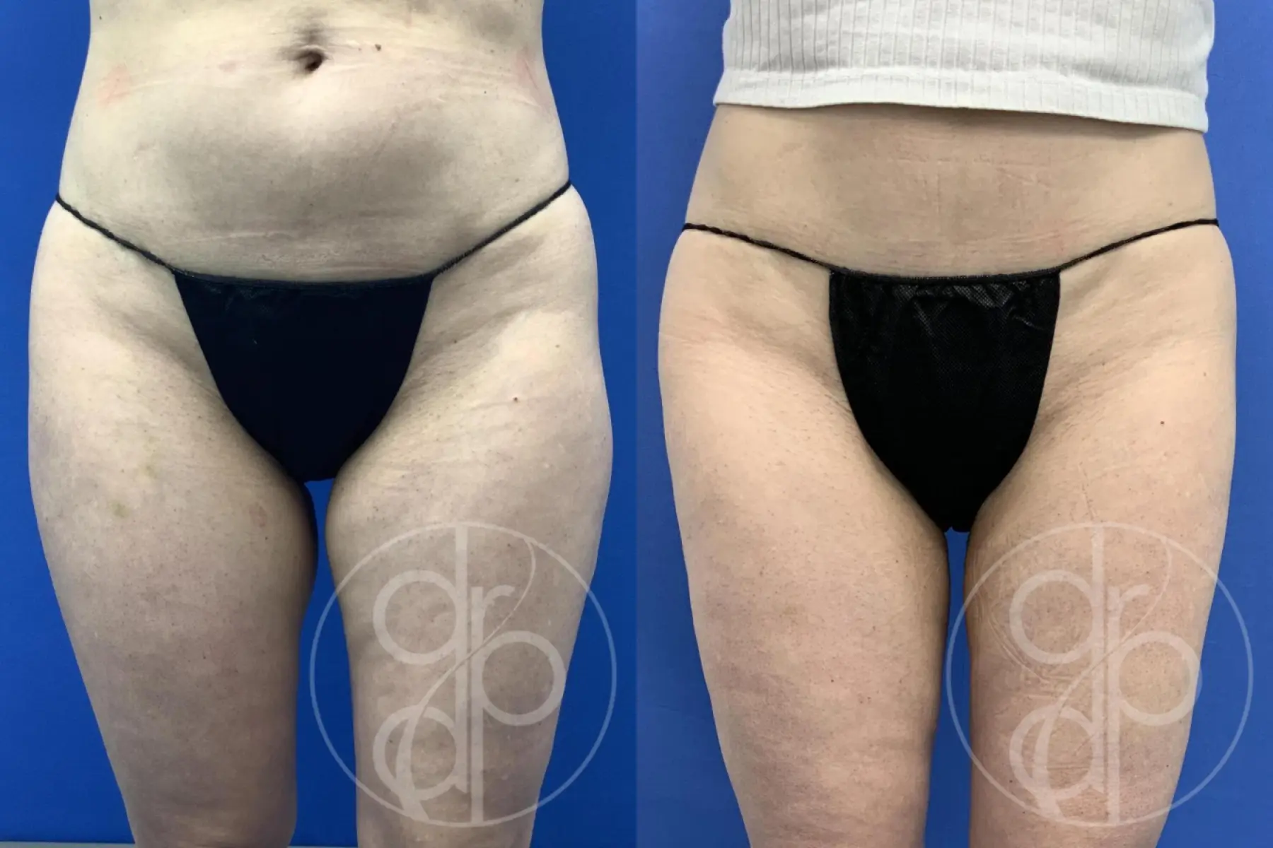 patient 14634 liposuction before and after result - Before and After