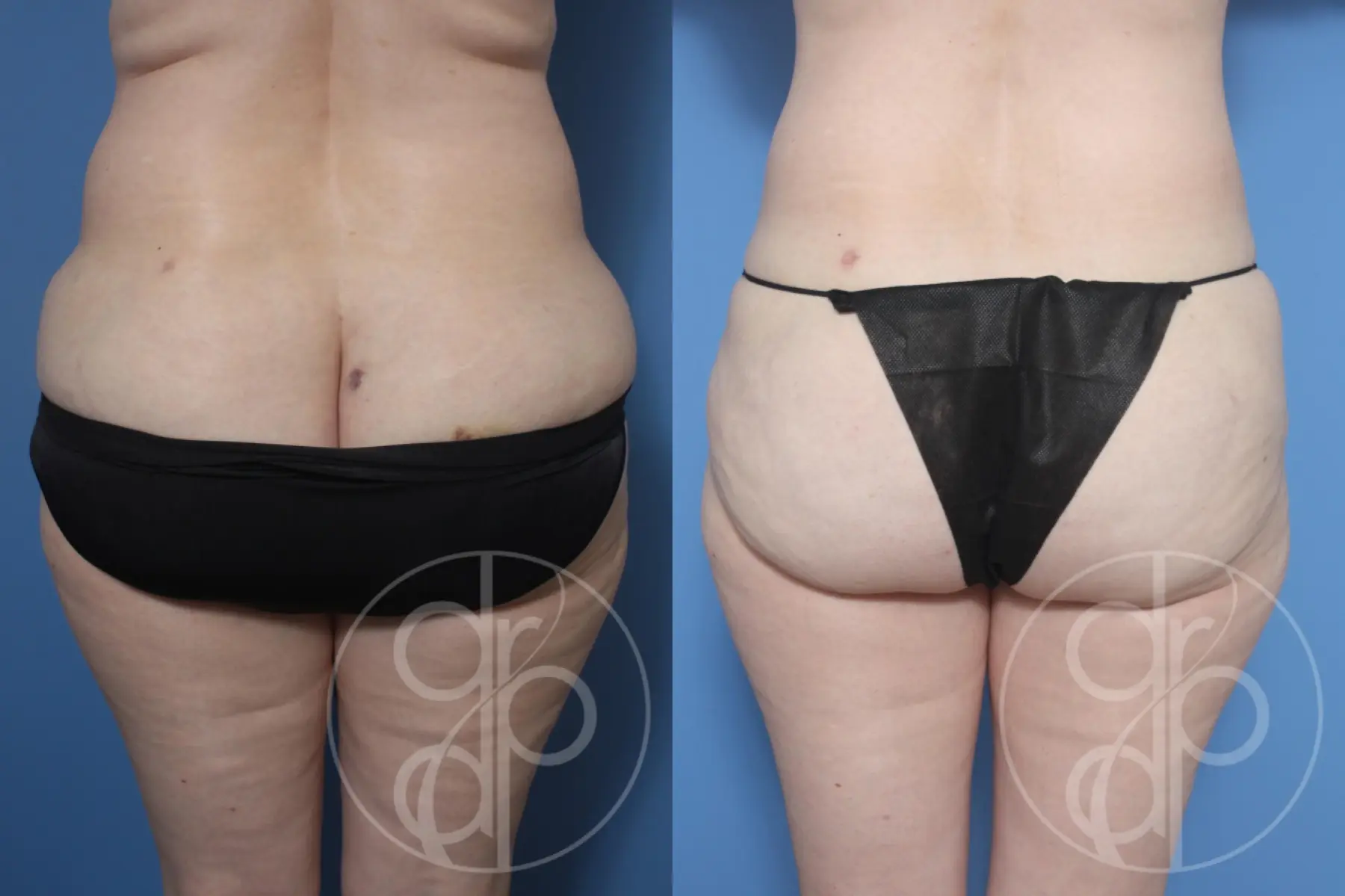 patient 13080 liposuction before and after result - Before and After 2