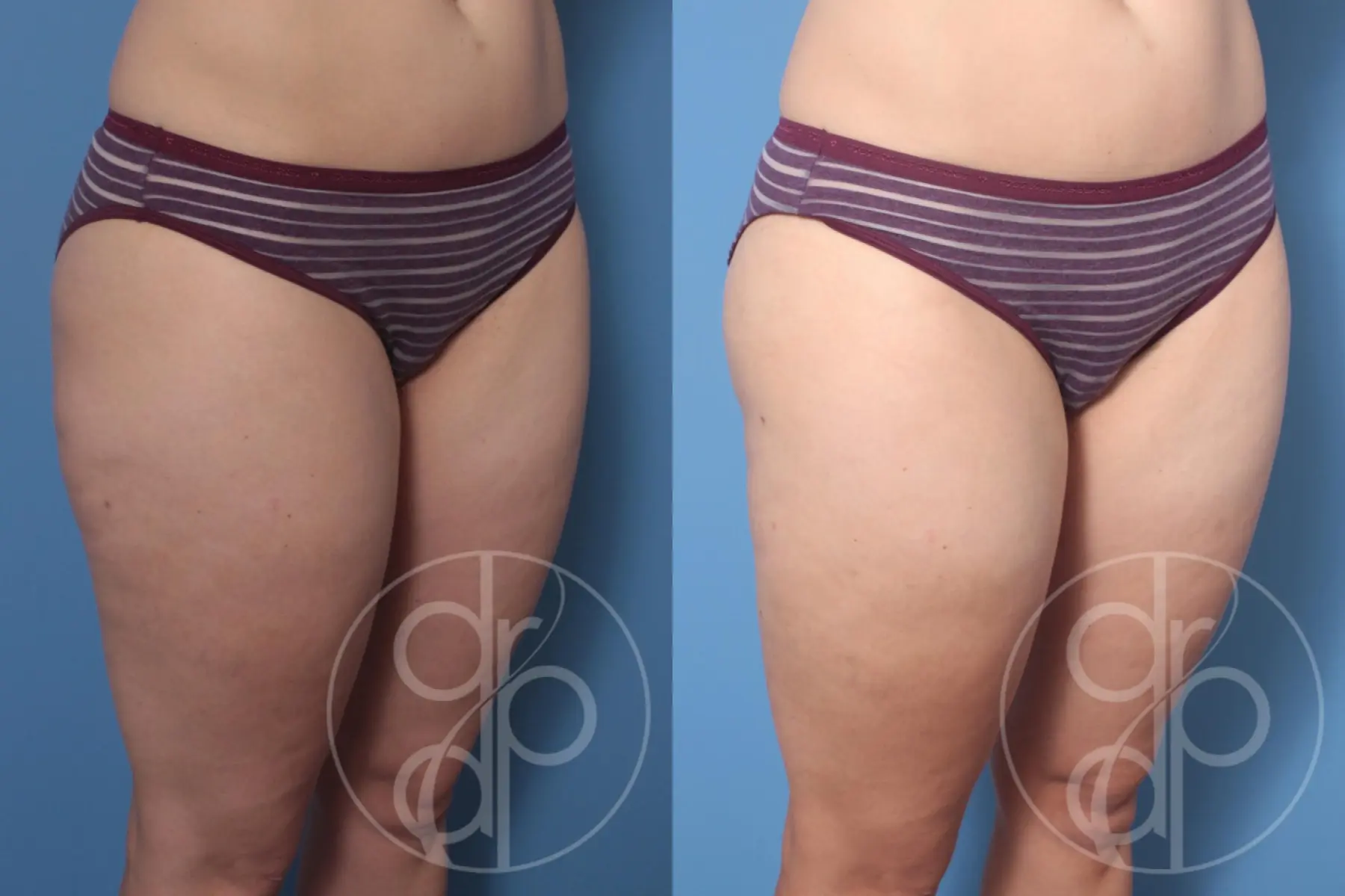 patient 10315 liposuction before and after result - Before and After 3