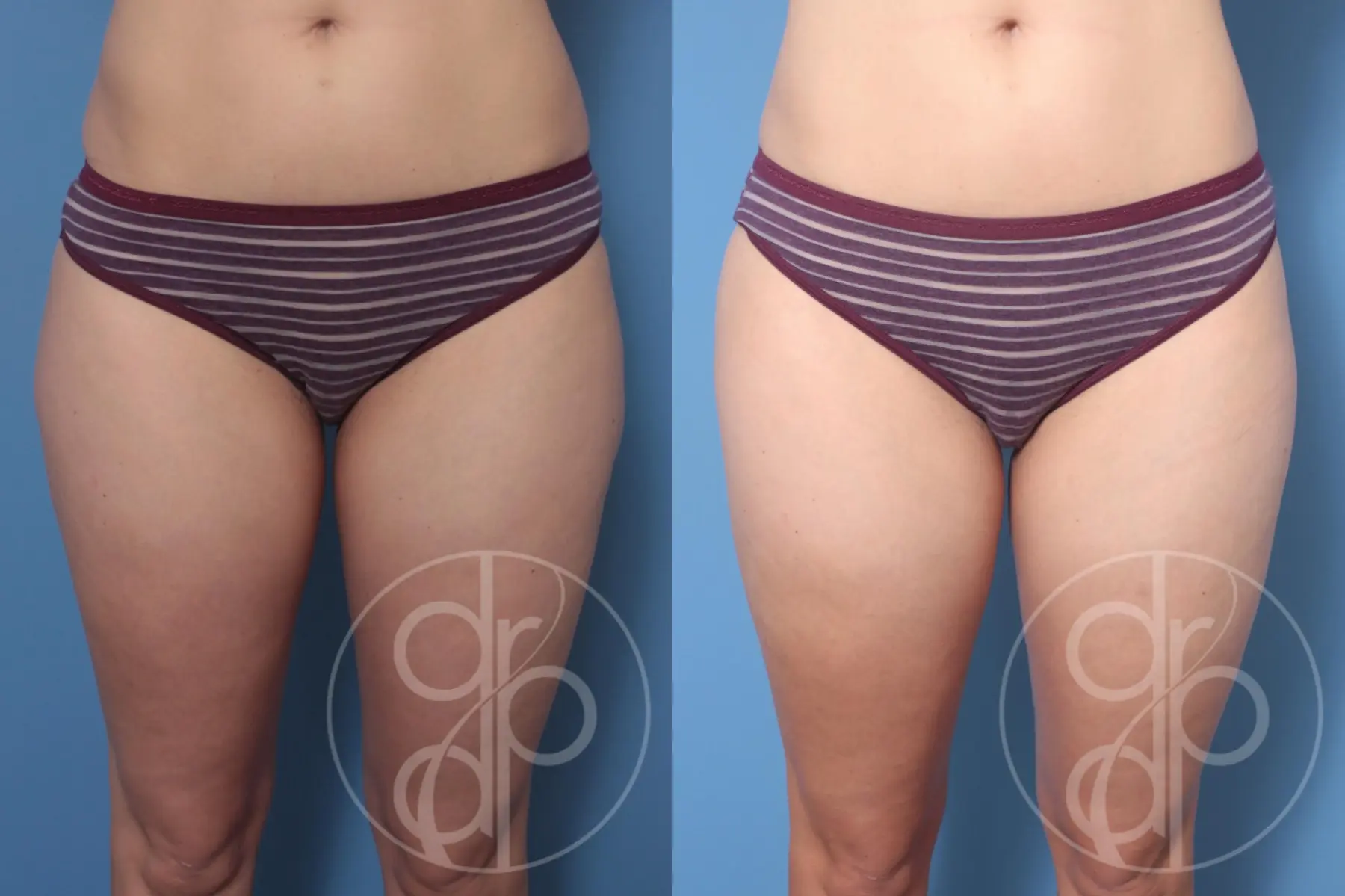 patient 10315 liposuction before and after result - Before and After 1