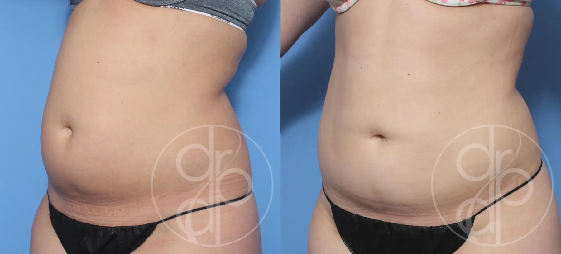 patient 12394 liposuction before and after result - Before and After 2