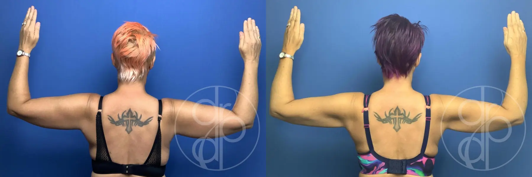 patient 13370 liposuction before and after result - Before and After