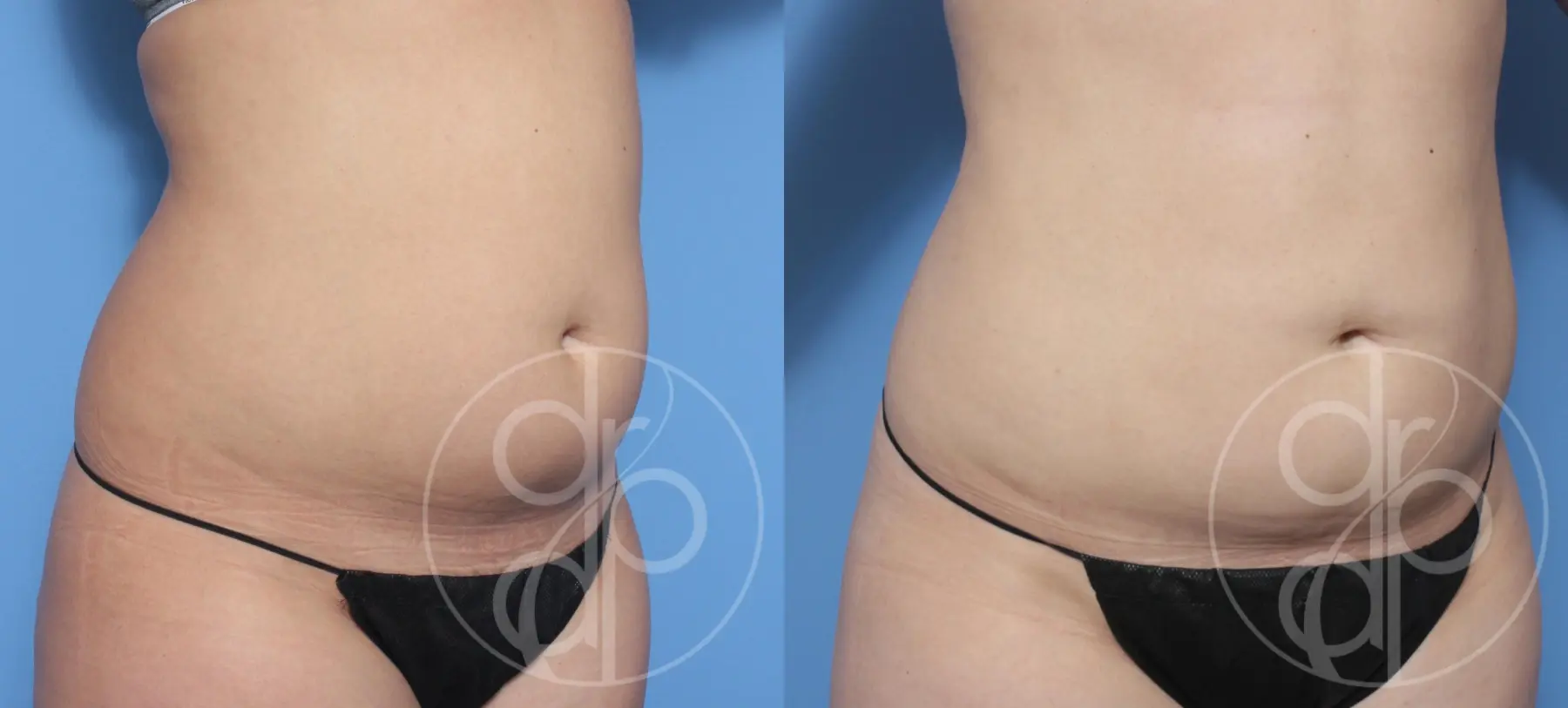 patient 12394 liposuction before and after result - Before and After 3