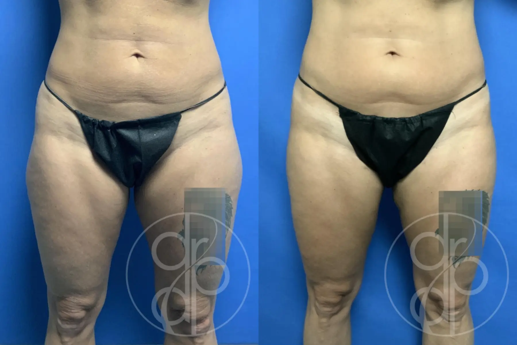patient 12320 liposuction before and after result - Before and After 1