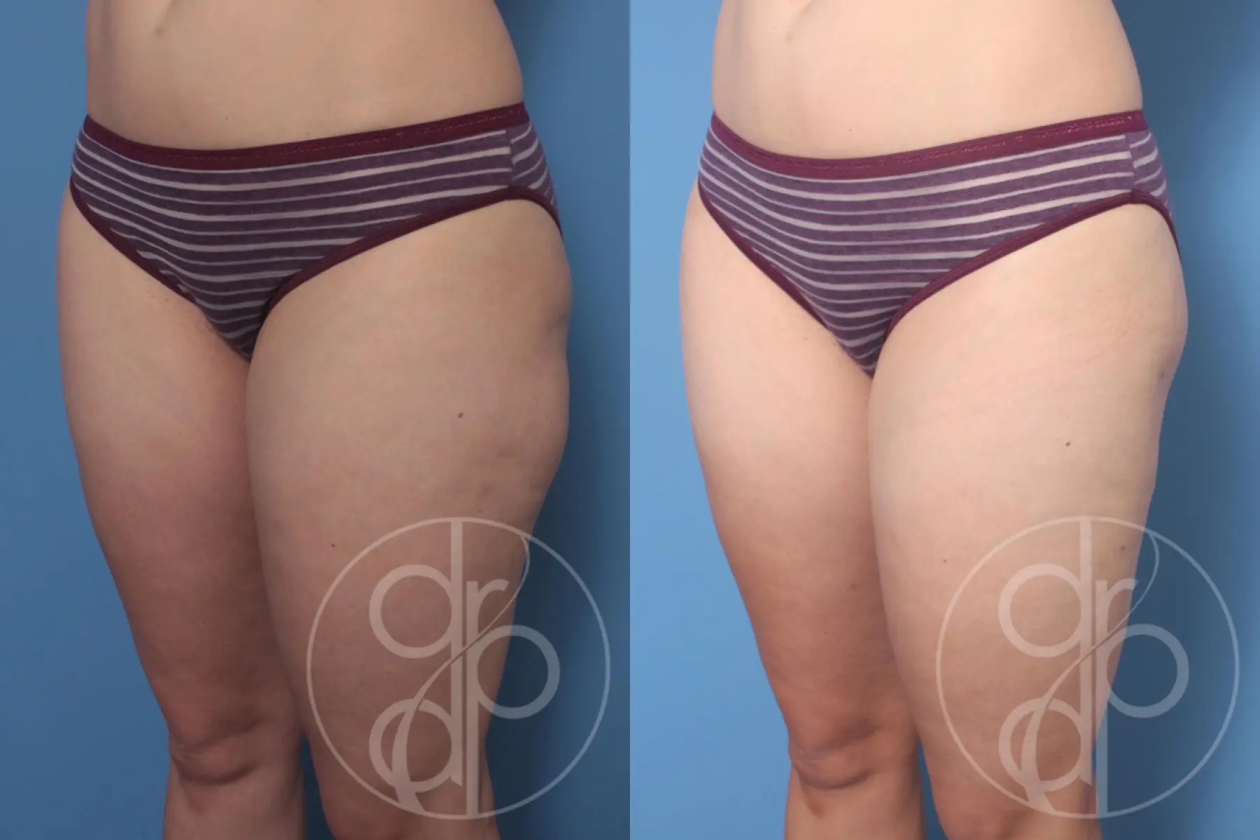 patient 10315 liposuction before and after result - Before and After 2