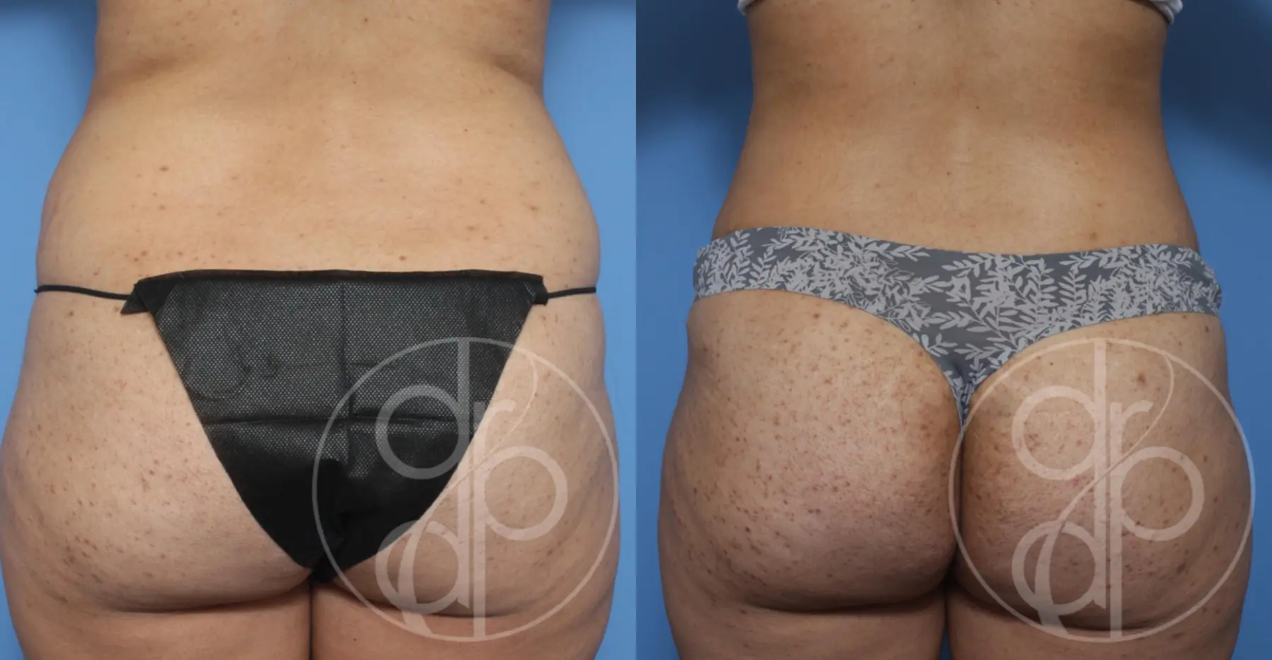 patient 10109 liposuction before and after result - Before and After 1