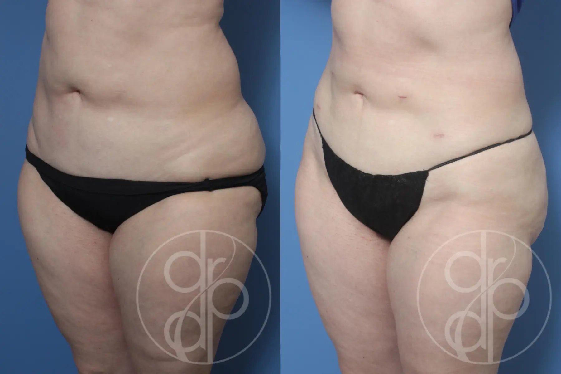 patient 13080 liposuction before and after result - Before and After 3