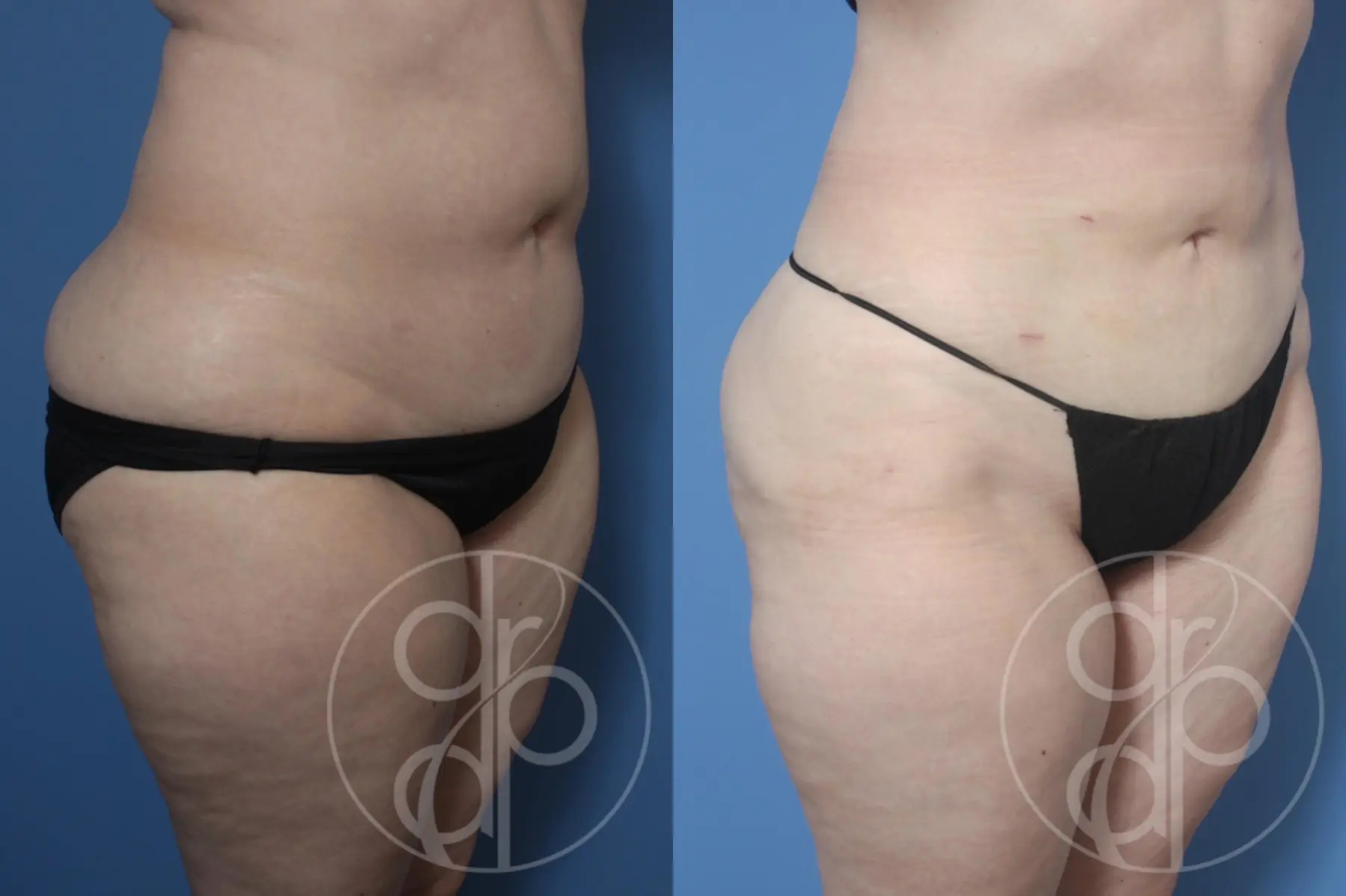 patient 13080 liposuction before and after result - Before and After 4