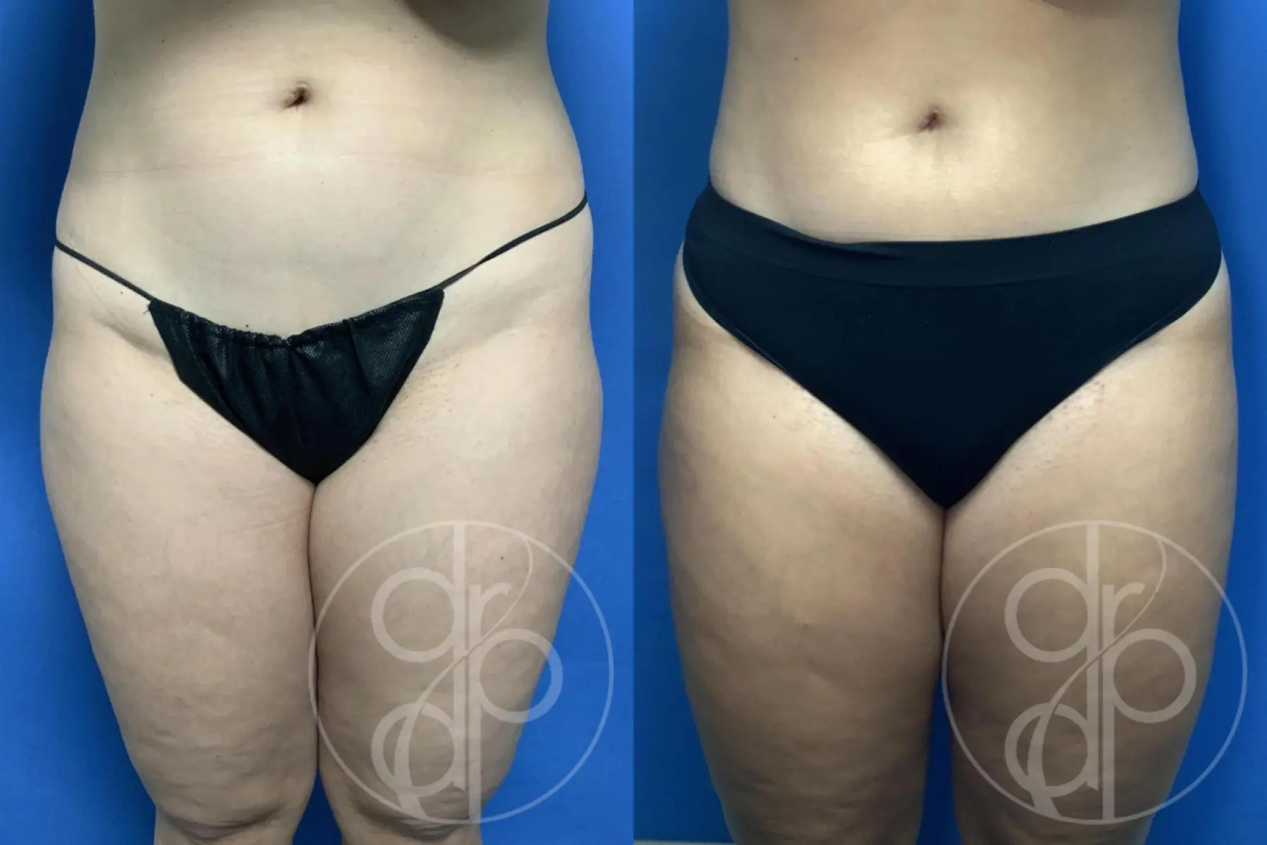 patient 13930 liposuction before and after result - Before and After