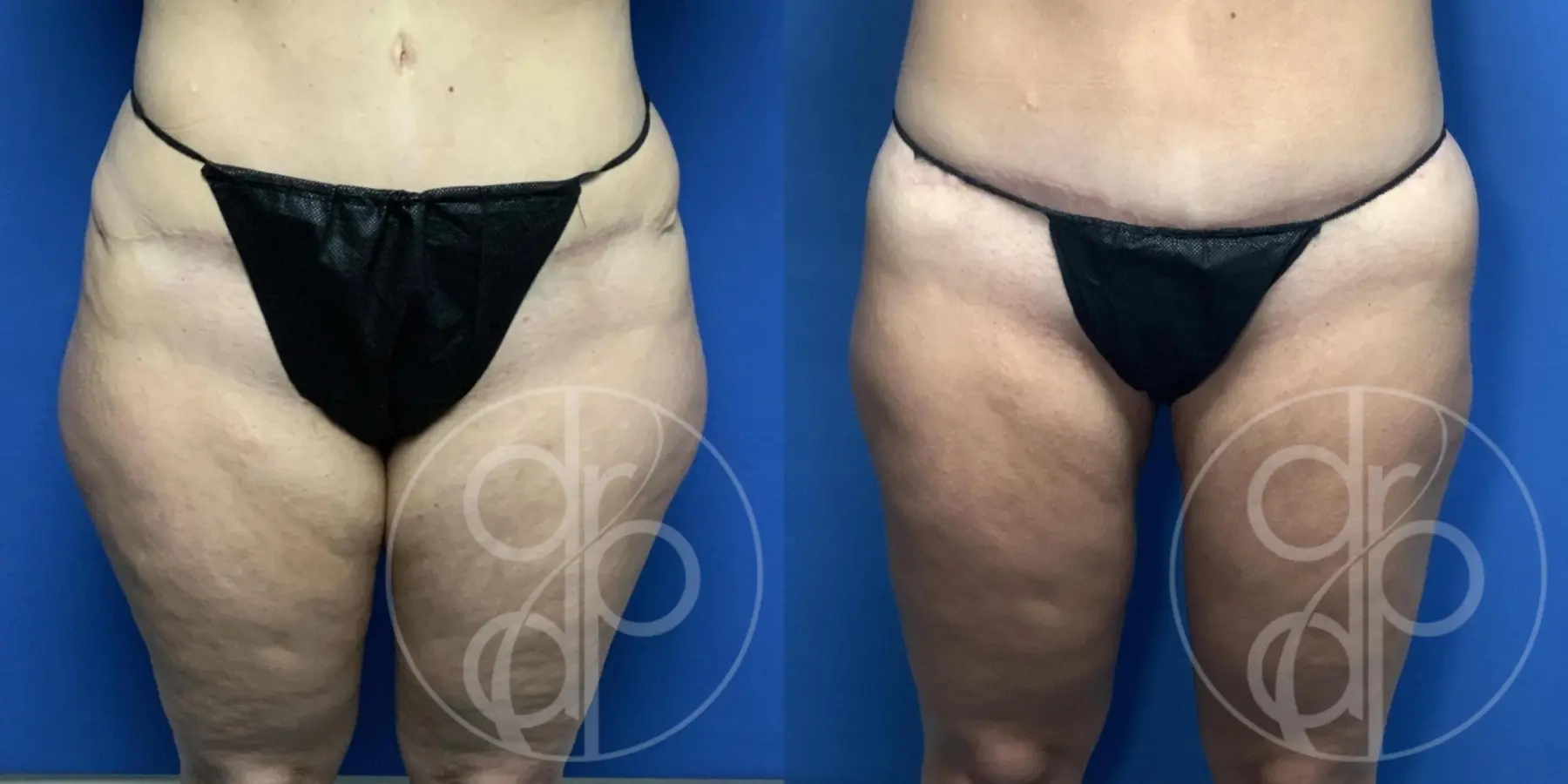 patient 13450 liposuction before and after result - Before and After