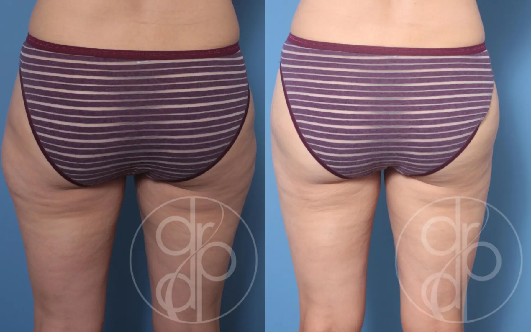 patient 10315 liposuction before and after result - Before and After 4