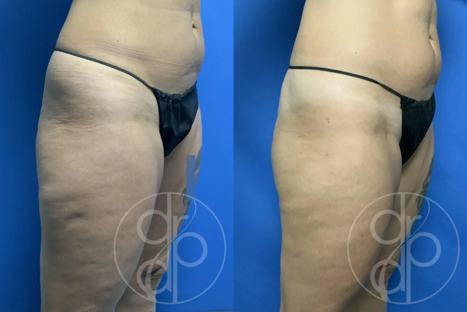 patient 12320 liposuction before and after result - Before and After 2