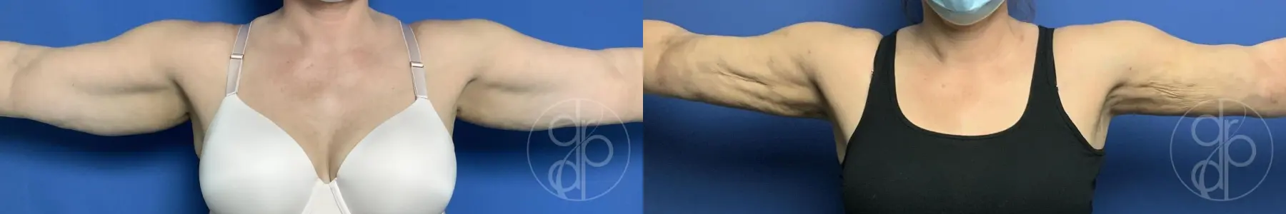 Liposuction: Patient 1 - Before and After  