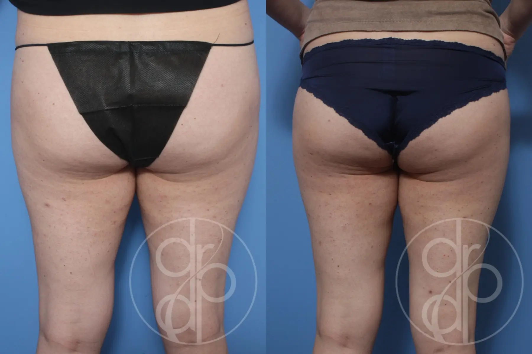 patient 10292 liposuction before and after result - Before and After 2
