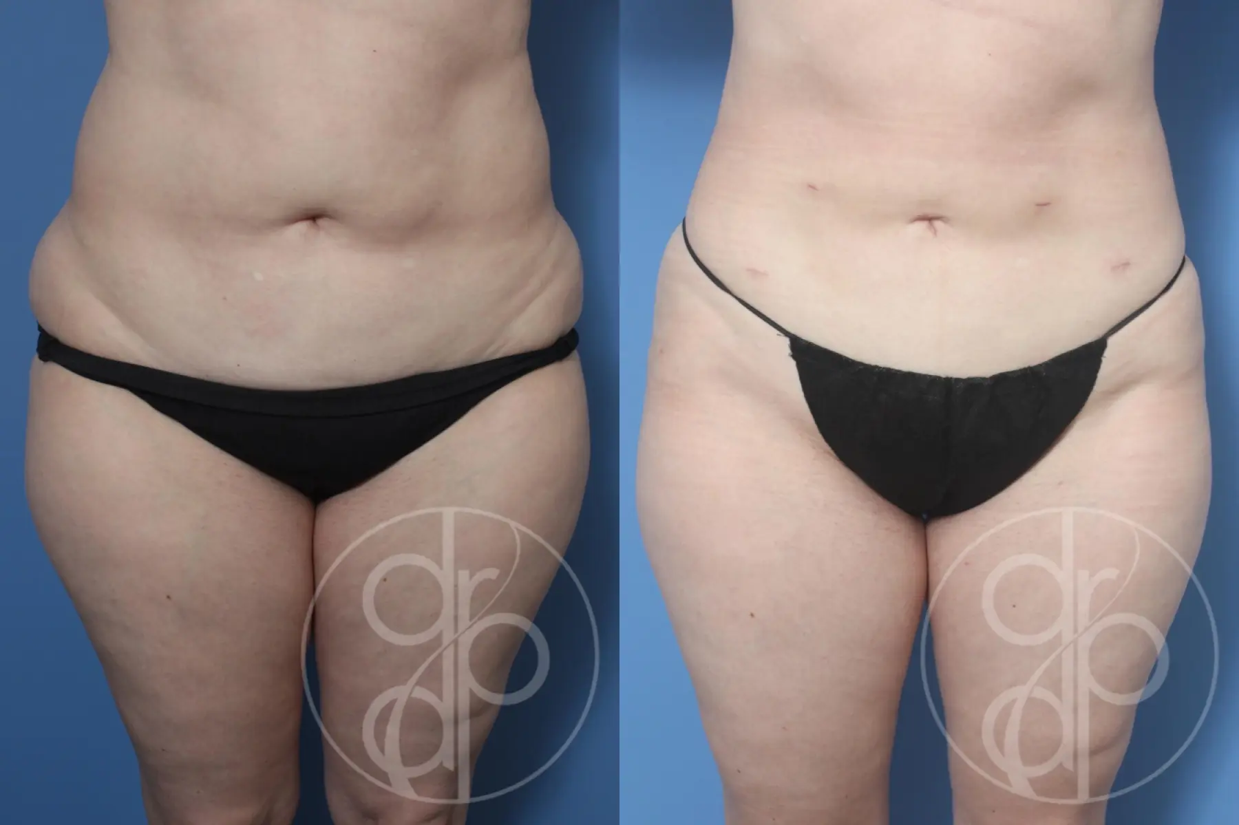 patient 13080 liposuction before and after result - Before and After 1