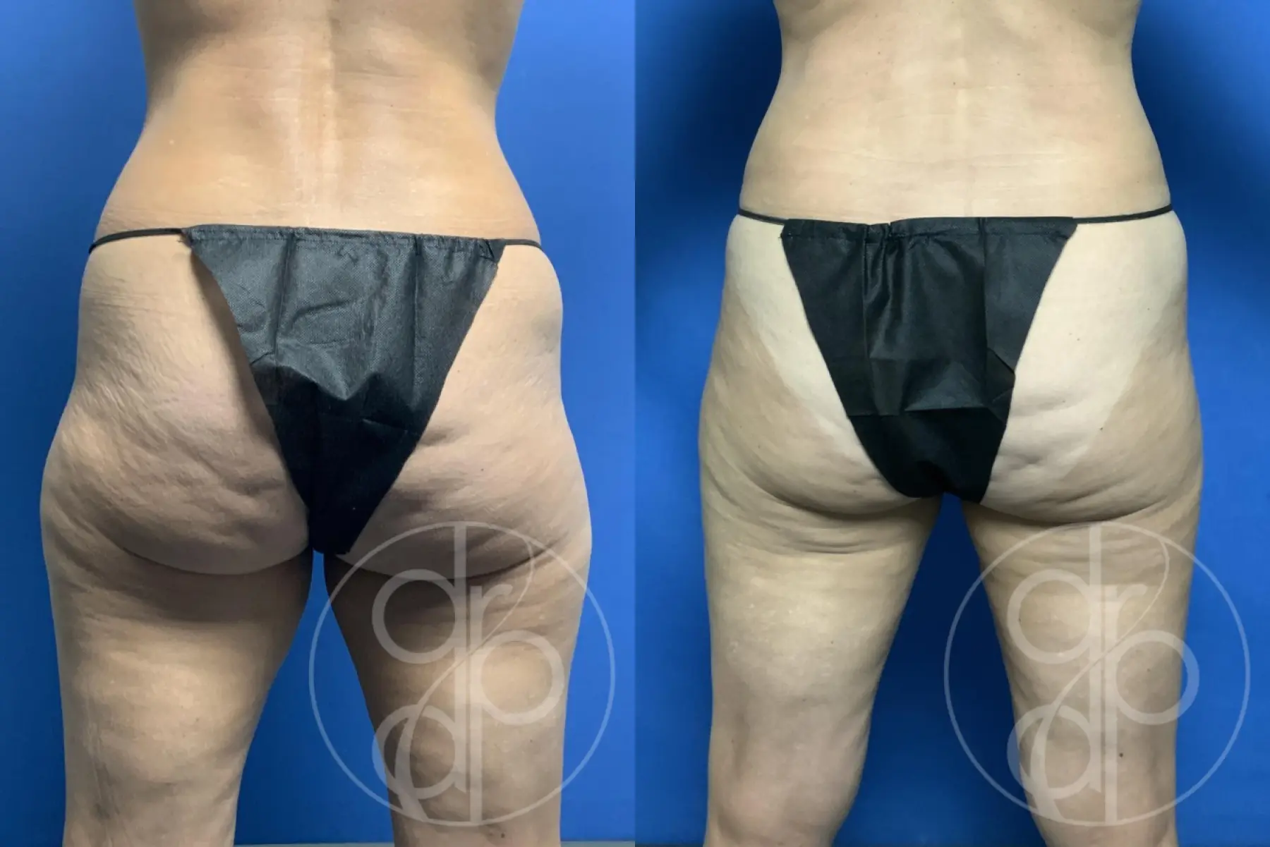 patient 12320 liposuction before and after result - Before and After 4
