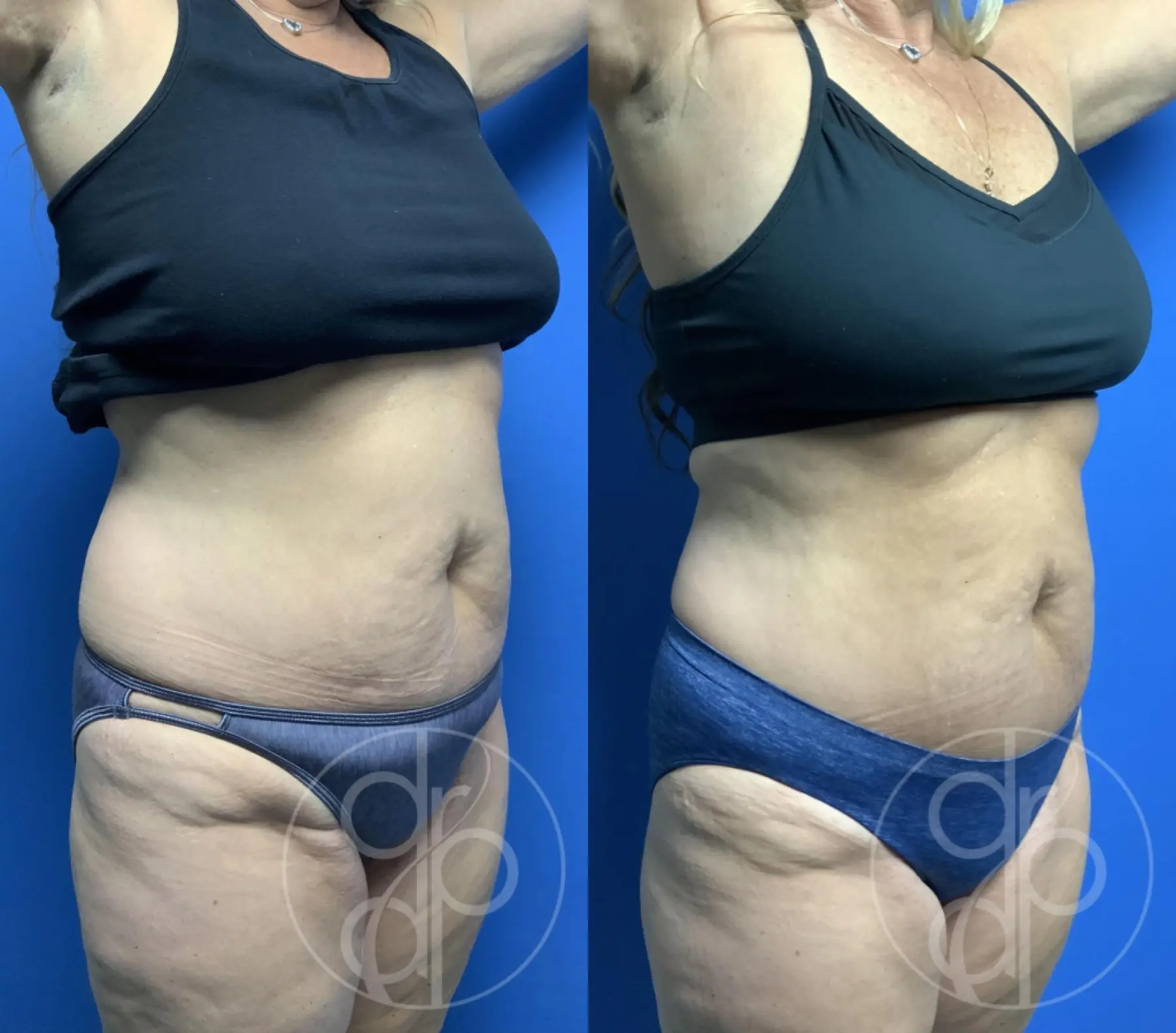 patient 12239 mini tummy tuck before and after result - Before and After 3