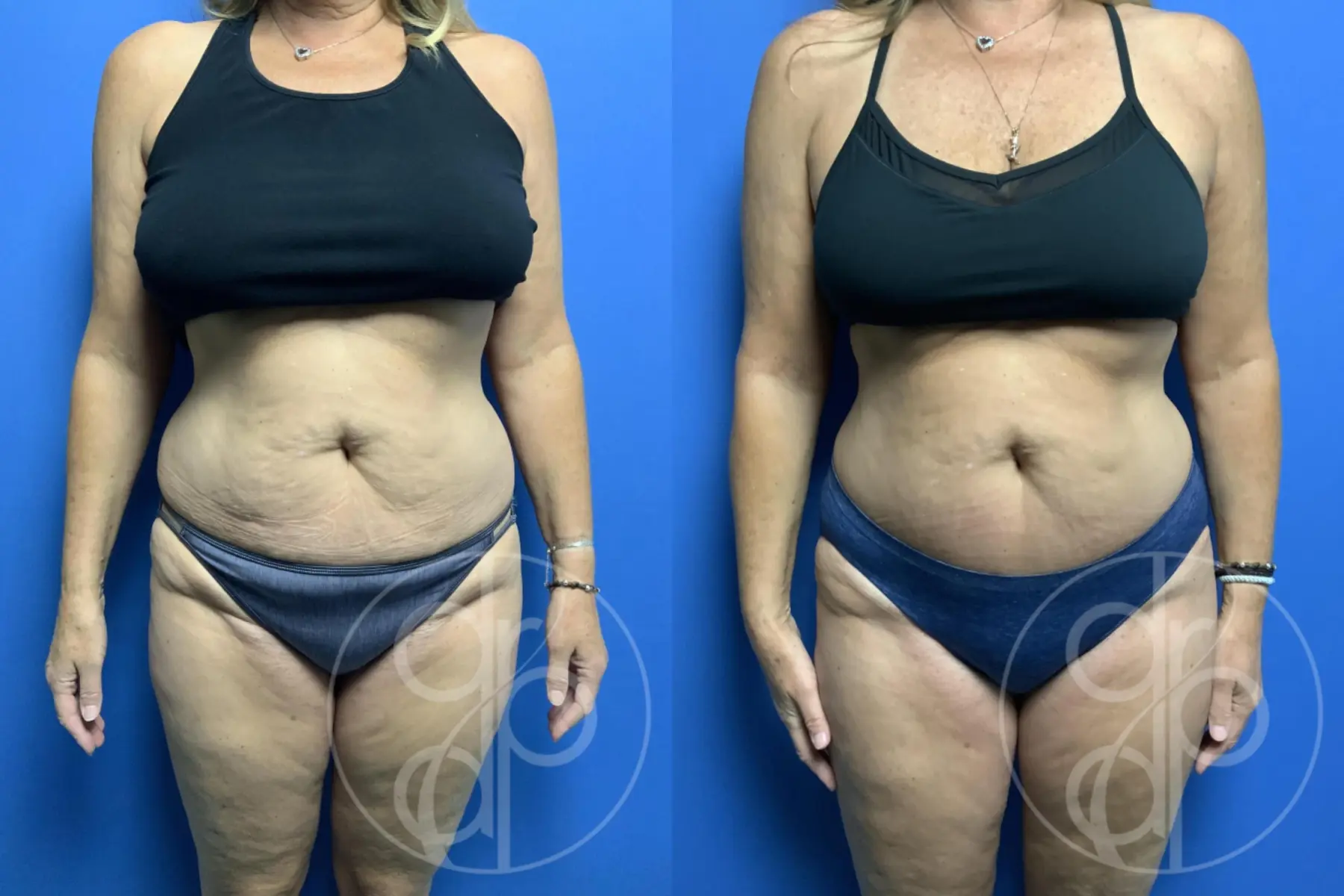 Mini Tummy Tuck: Patient 1 - Before and After  