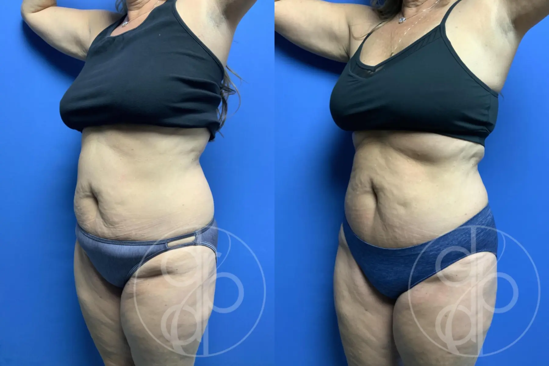 patient 12239 mini tummy tuck before and after result - Before and After 2