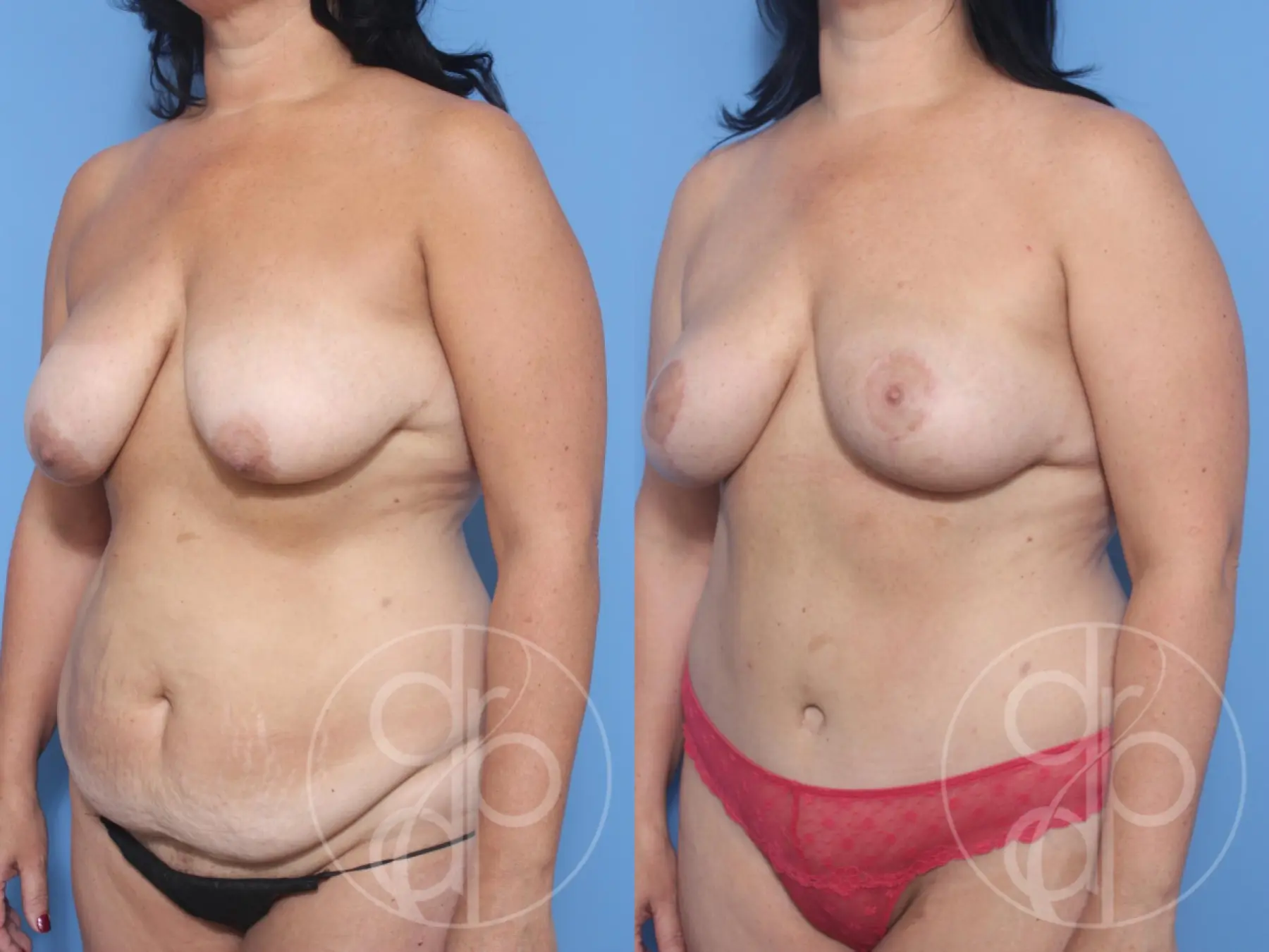 patient 12375 mommy makeover before and after result - Before and After 3