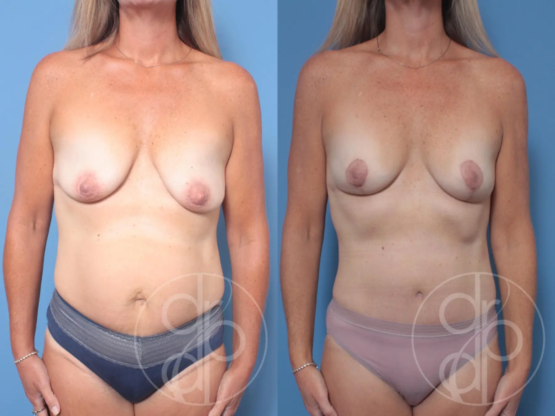patient 10149 mommy makeover before and after result - Before and After 1