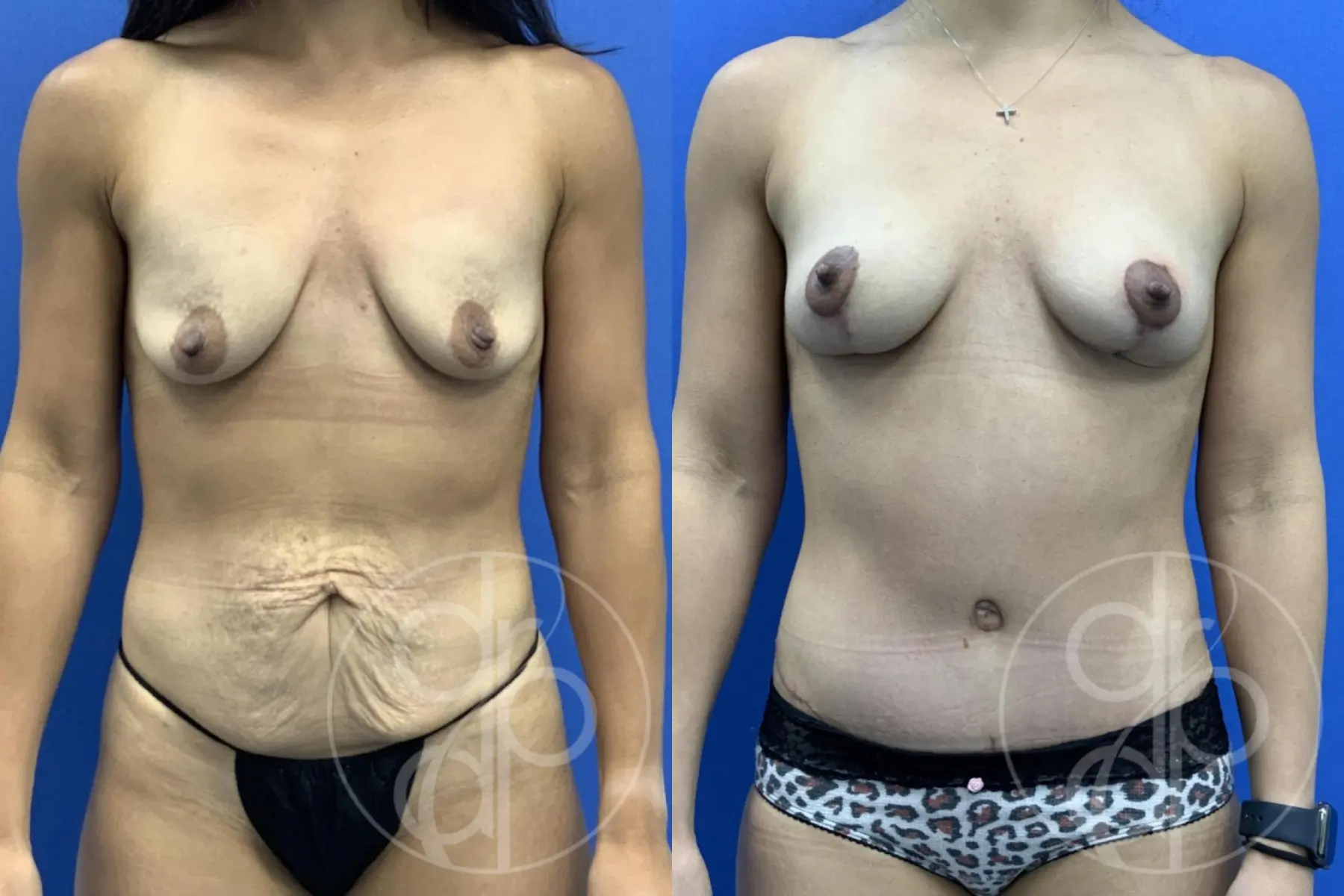 Mommy Makeover: Patient 4 - Before and After  