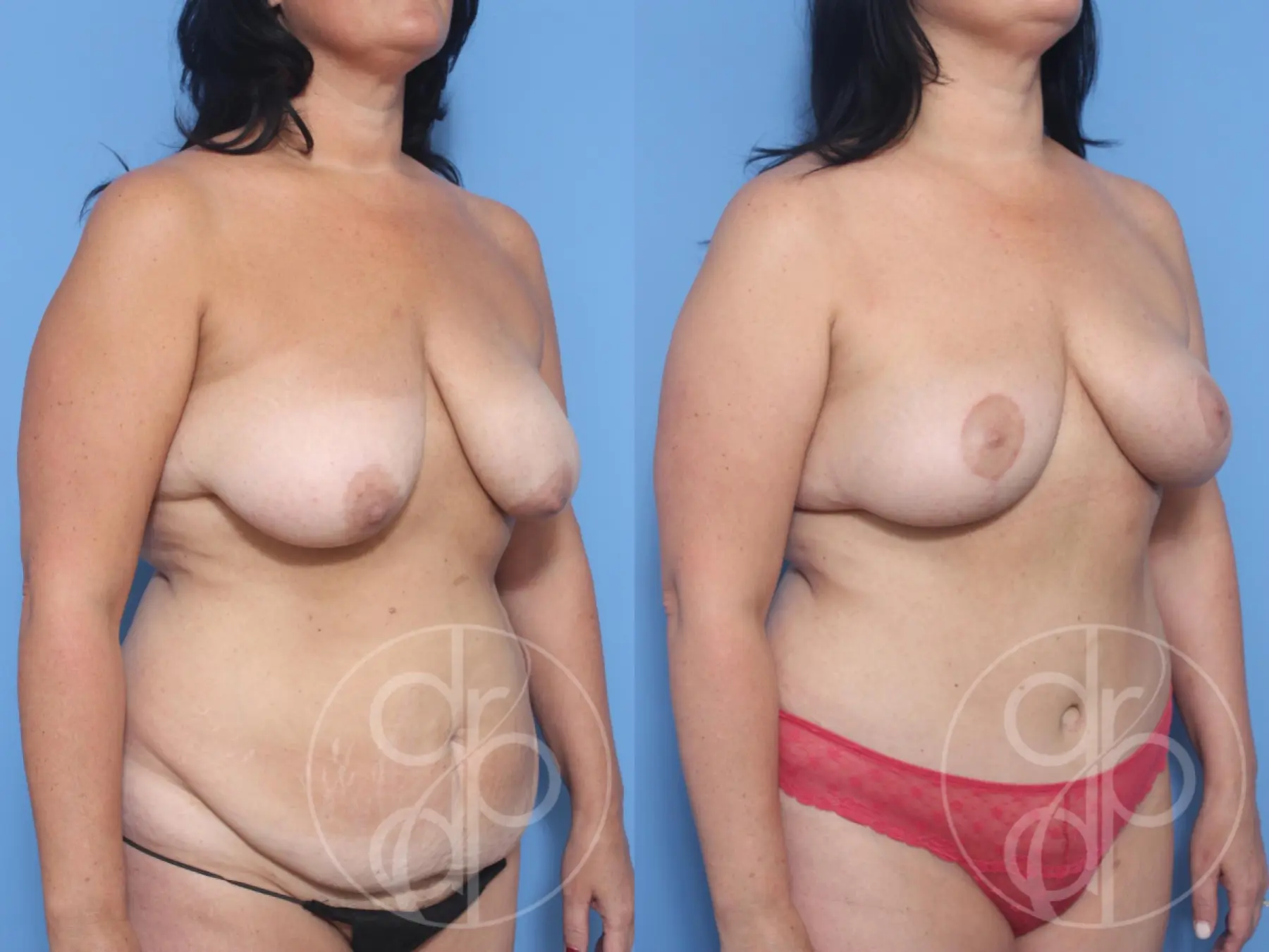 patient 12375 mommy makeover before and after result - Before and After 2