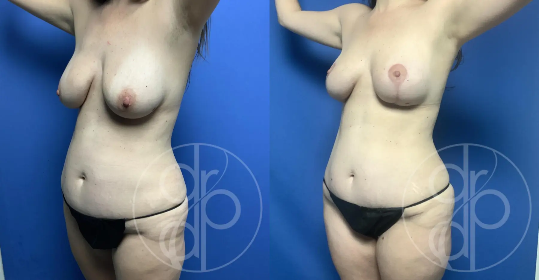 patient 12662 mommy makeover before and after result - Before and After 3