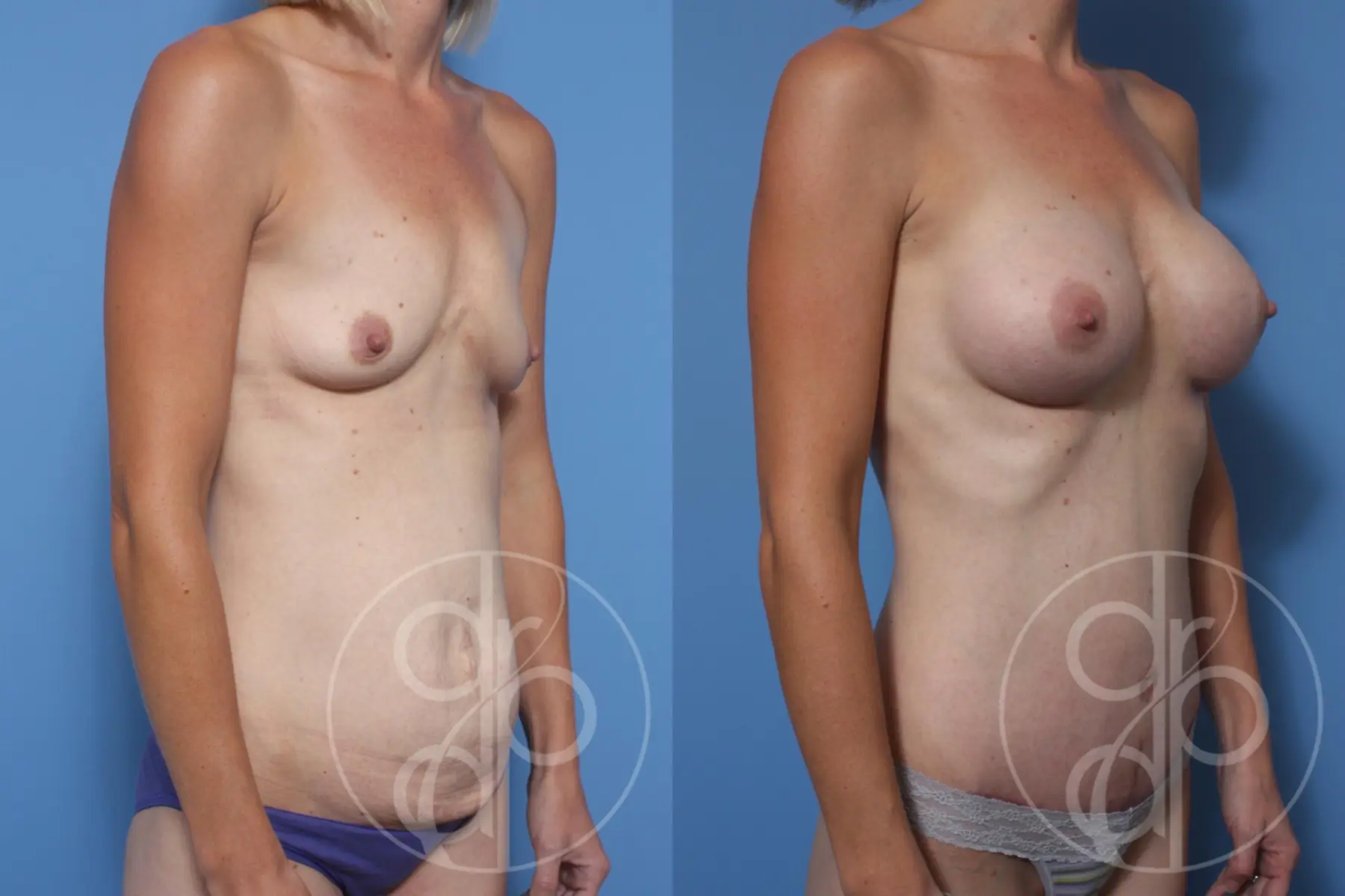 patient 13150 mommy makeover before and after result - Before and After 2