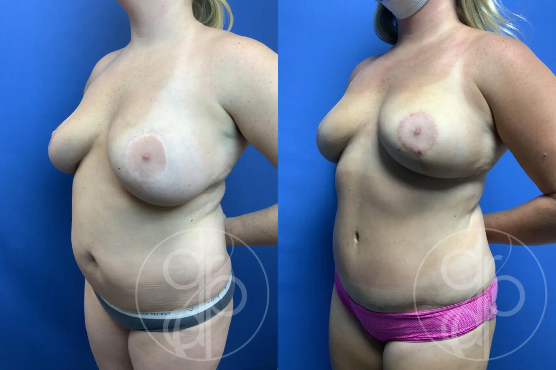 patient 10771 mommy makeover before and after result - Before and After 3