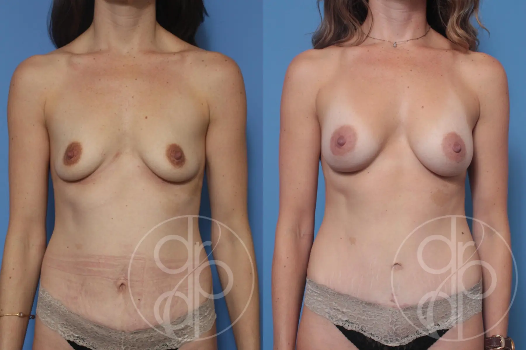 patient 10204 mommy makeover before and after result - Before and After 1